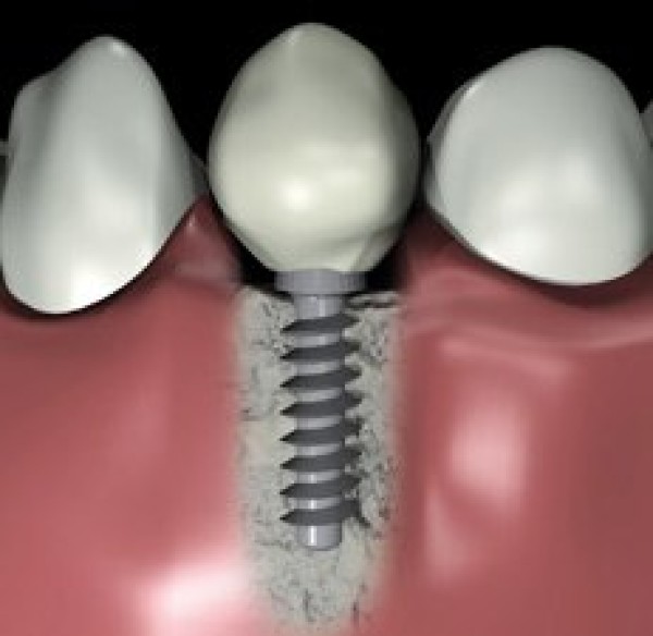 Qu’est-ce qu’un implant dentaire ?