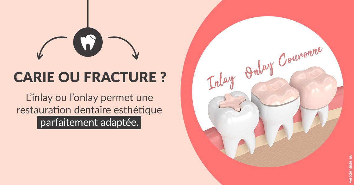 https://www.drs-mamou.fr/T2 2023 - Carie ou fracture 2