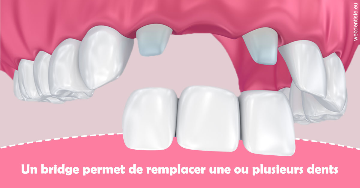 https://www.drs-mamou.fr/Bridge remplacer dents 2