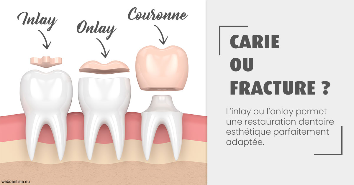 https://www.drs-mamou.fr/T2 2023 - Carie ou fracture 1
