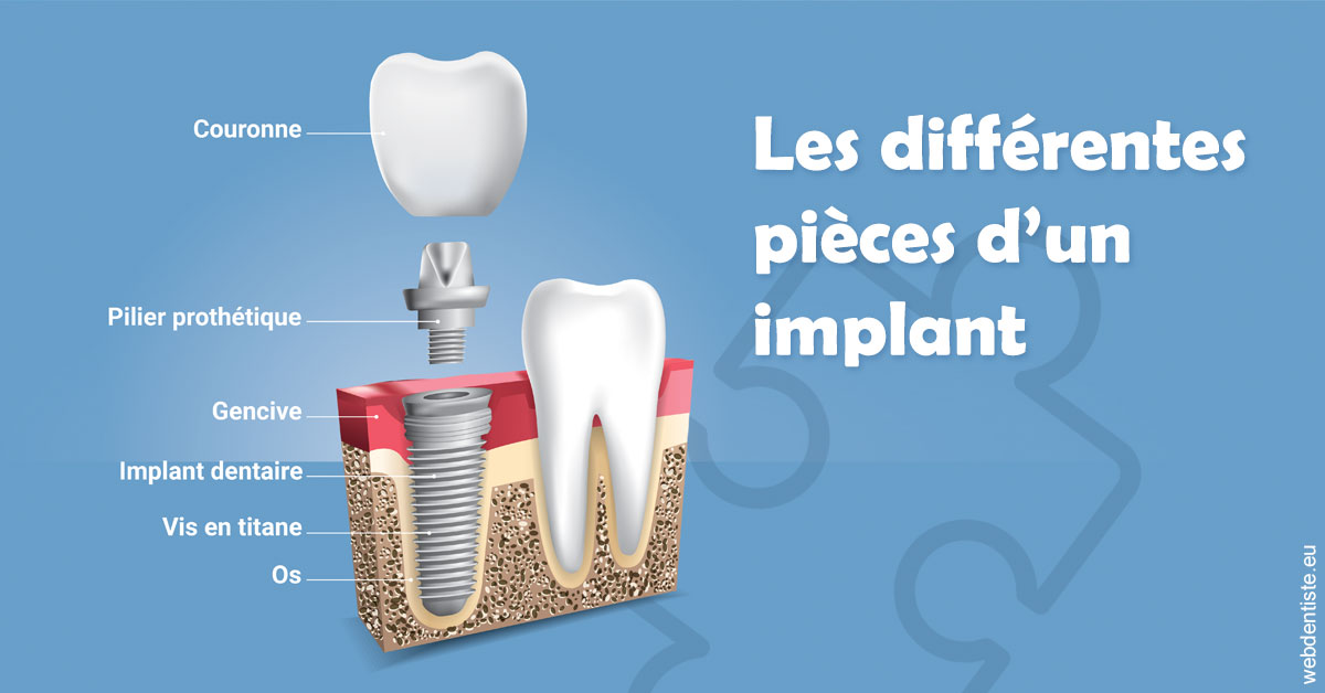 https://www.drs-mamou.fr/Les différentes pièces d’un implant 1