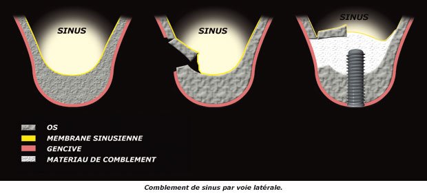 sinus-lateral1